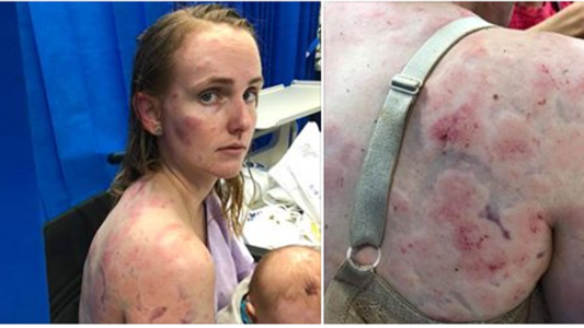 Así quedó la espalda de una mujer que protegió a su bebé de una granizada