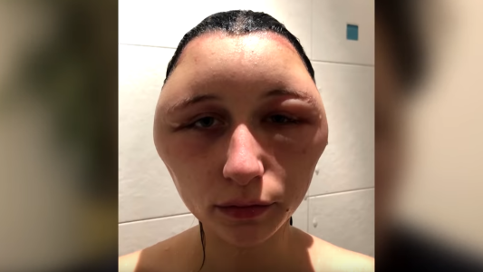 Se tiñó el pelo y terminó con la cabeza totalmente deformada: "Casi muero"