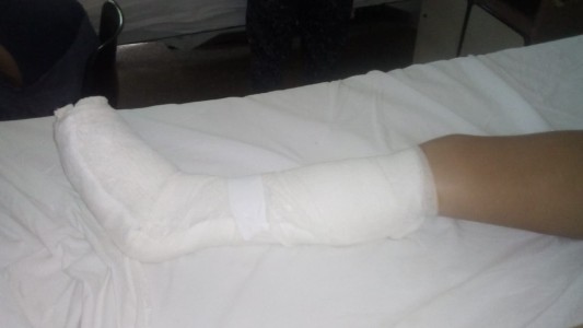 Así fue el accidente por el que le amputaron los dedos del pie a una niña en un parque