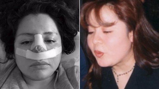 Se sometió a una liposucción, pero al médico no le gustó su nariz y también se la operó