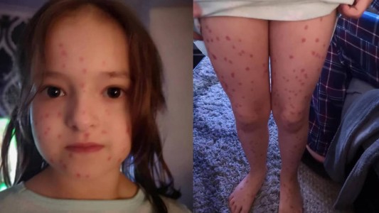 Nena se pinto puntitos rojos para fingir que tenía varicela y faltar al colegio: pero la trampa le salió mal