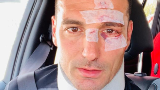 Así quedó Lionel Scaloni tras el accidente