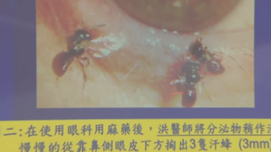 Impresionante: ¡Una mujer tenía en un ojo cuatro abejas vivas!