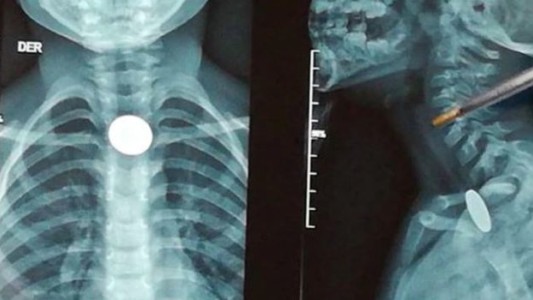 Un nene lleva 7 días atragantado con una moneda y no autorizan su extracción