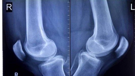 "Fabela", el hueso que se creía perdido y volvió a aparecer en el cuerpo del ser humano