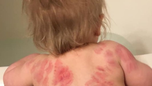 Fue a buscar a su bebé a la guardería y lo encontró con decenas de mordeduras en la espalda