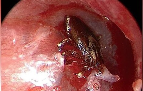 Sentía un zumbido, fue al hospital y le sacaron una garrapata del oído