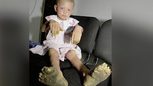 La triste historia de la primera "nena árbol" de América Latina