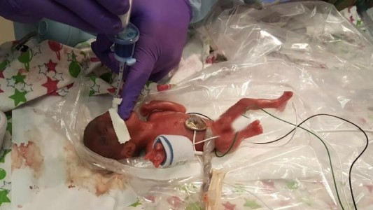 Nació la beba más pequeña del mundo: pesó 245 gramos tras 23 días de gestación