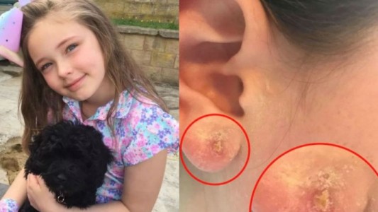 Fue a ponerle aritos a su hija de 10 años y la nena terminó internada por una infección