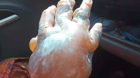 Un doctor advirtió sobre el peligro de usar pasta dental en caso de una quemadura