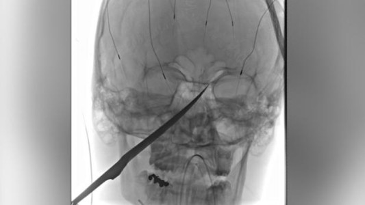 Extrajeron con éxito un cuchillo de 25 centímetros clavado en el cráneo de un chico