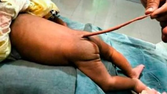 El caso del bebé que nació con una "cola de ratón"