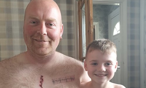 El padre que se tatuó la cicatriz que tiene su hijo por una operación