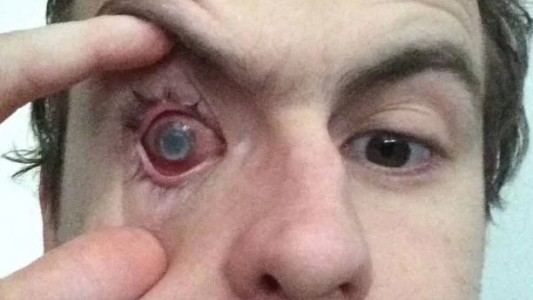 El drama de un joven inglés que se duchó con los lentes de contacto y se quedó ciego