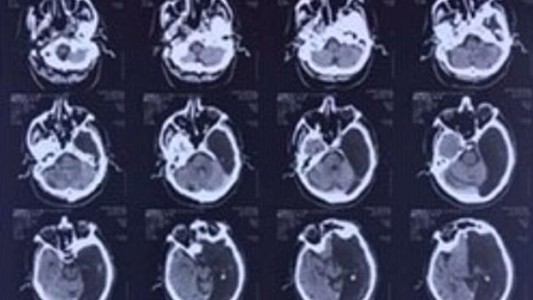 El ruso que vivió 60 años una "vida normal" con la mitad de su cerebro