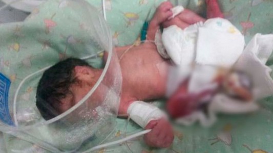Tienen que amputar a una beba que quemaron en un hospital