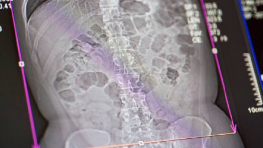 Sufría dolores en el estómago: lo operaron y le extrajeron a su gemelo con pelos y dientes