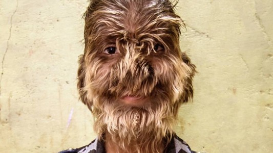 Alarma por chicos que sufren el "síndrome del hombre lobo", luego de tomar un medicamento contaminado