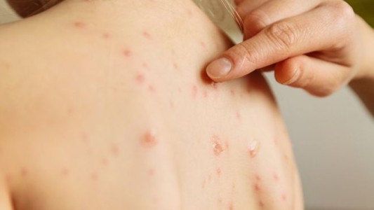 Sarampión: recomiendan aplicarse una vacuna gratuita