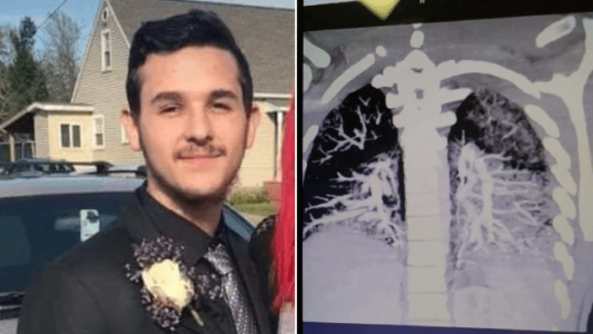 La impactante radiografía del joven de 19 años que tiene pulmones de un fumador de 60 por el cigarrillo electrónico