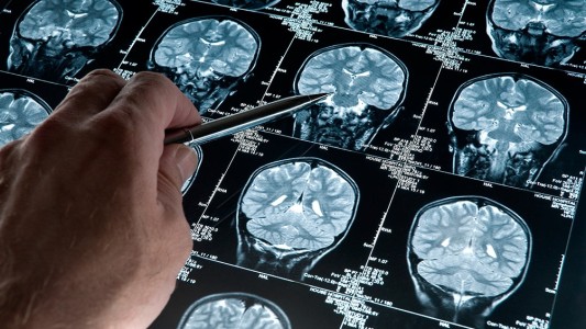 Inédito: logran frenar el Alzheimer en ratones y hay expectativa por su aplicación en humanos
