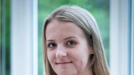 Así le reconstruyeron la cara a una joven que casi pierde la mandíbula en un accidente