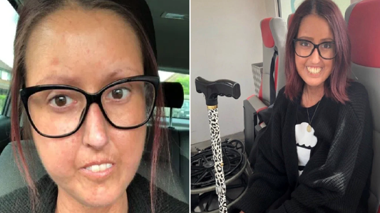 La rara enfermedad que endurece la piel: el drama de Georgina