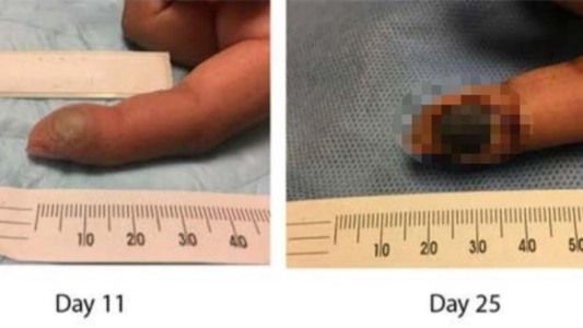 Así le quedó el dedo a una auxiliar de laboratorio que se contagió el virus de la viruela por un pinchazo accidental