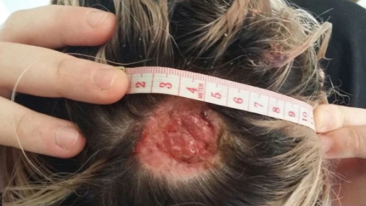Fue a una peluquería a teñirse el pelo de rosa y perdió parte de su cuero cabelludo