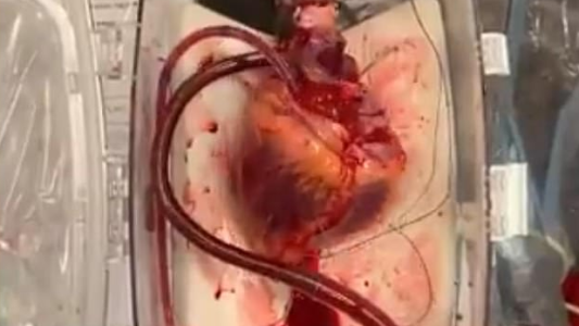 Video: revivieron un "corazón muerto" para usarlo en un trasplante