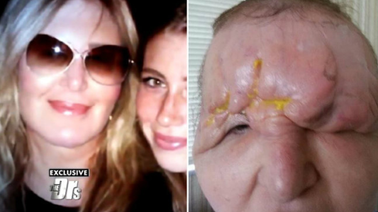 Una modelo quedó ciega y con la cara deformada tras inyectarse ácido hialurónico