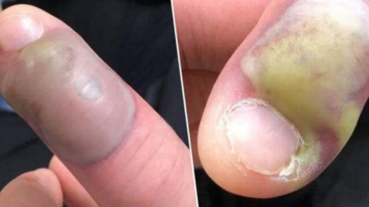 Imágenes impactantes: sufrió una grave infección por morderse las uñas