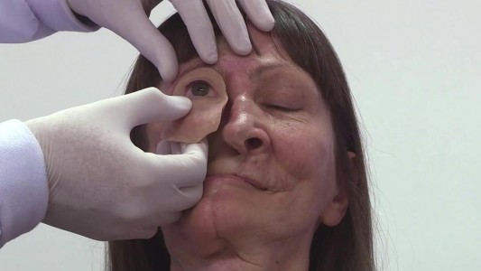 Prótesis de bajo costo para sobrevivientes de cáncer