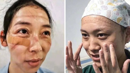 Las marcas en la cara de las enfermeras chinas que luchan contra el coronavirus en Wuhan