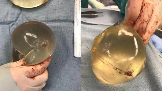 Le dispararon y salvó su vida por los implantes de siliconas que tenía en los pechos