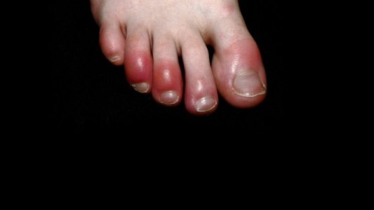 "Dedos coronavirus": el doloroso síntoma de covid-19 que advierten los dermatólogos