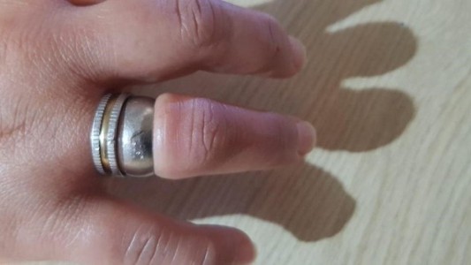 La historia de la mujer que se le trabó un anillo y tuvo que llamar a los bomberos para que la salven