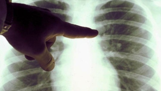 Científicos logran recuperar pulmones humanos dañadas tras "conectarlos" a cerdos vivos