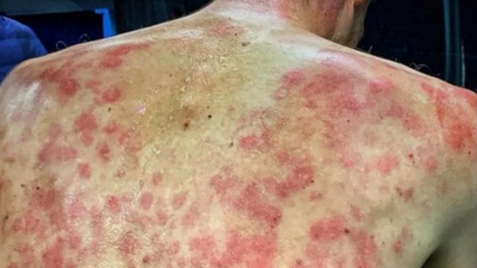 Tormenta de granizo durante la carrera: así le quedó la espalda a un ciclista