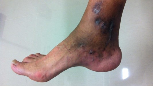 Micetoma: una enfermedad curable a la que llaman "muerte silenciosa"