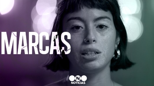 Marcas: Alanís venció las inseguridades por el vitiligo y ahora es modelo