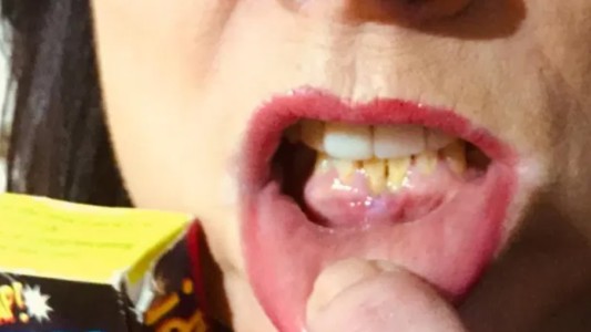 Sufrió quemaduras en la boca al confundir fuegos artificiales con caramelos