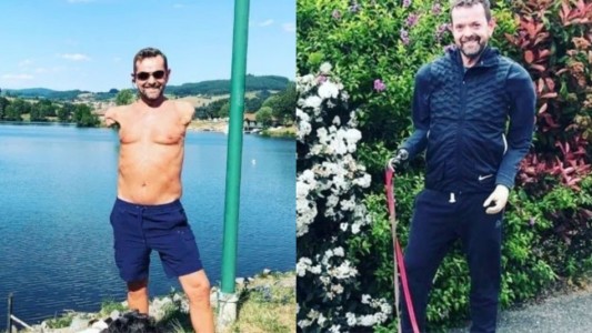 El testimonio del hombre que recibió el primer trasplante de brazos y hombros de la historia