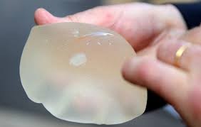 Confirman responsabilidad de certificador alemán en prótesis fraudulentas PIP