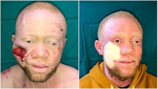 Le reconstruyeron la cara a un hombre que sufría un avanzado cáncer de piel