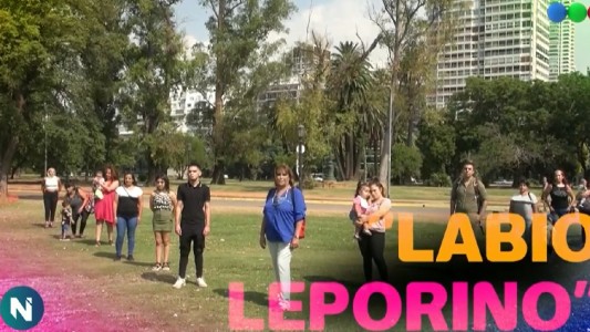 Minorías: FLAP o labio leporino