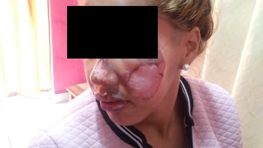 Detienen al hombre que le quemó la cara con una plancha a su novia