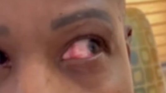 Se puso pegamento en el ojo al confundirse con las gotitas lubricantes