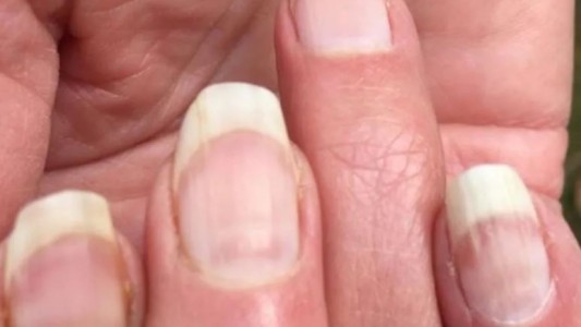 En las uñas se puede detectar si alguien tuvo coronavirus asintomático